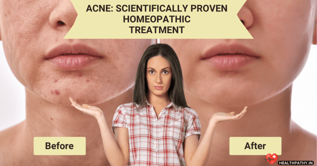 Acne Cures With Scientifically Proven Homeopathy