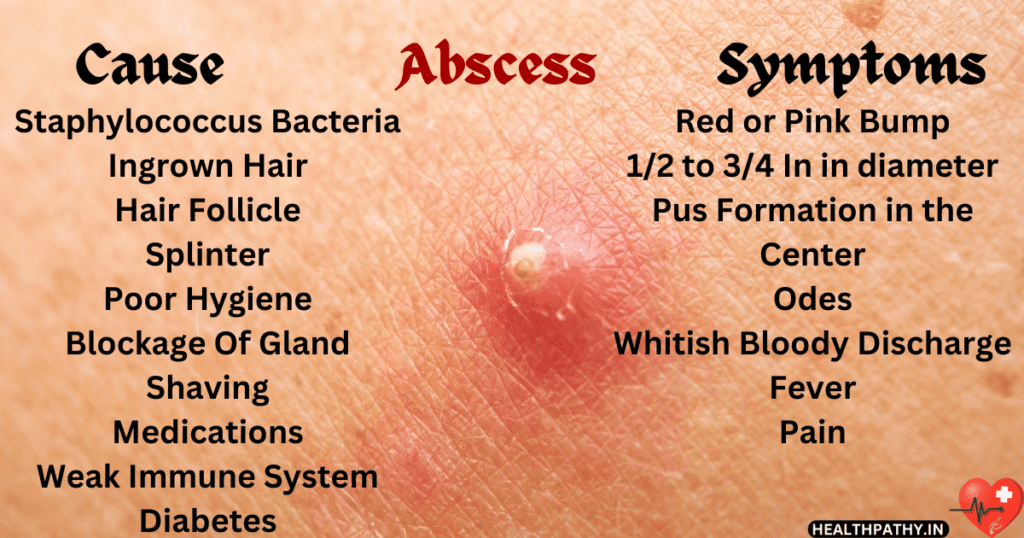 Abscess Cures With Scientifically Proven Homeopathy